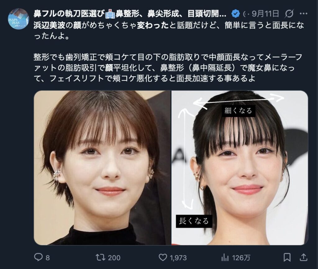 浜辺美波の顔の変化を解説しているXの投稿