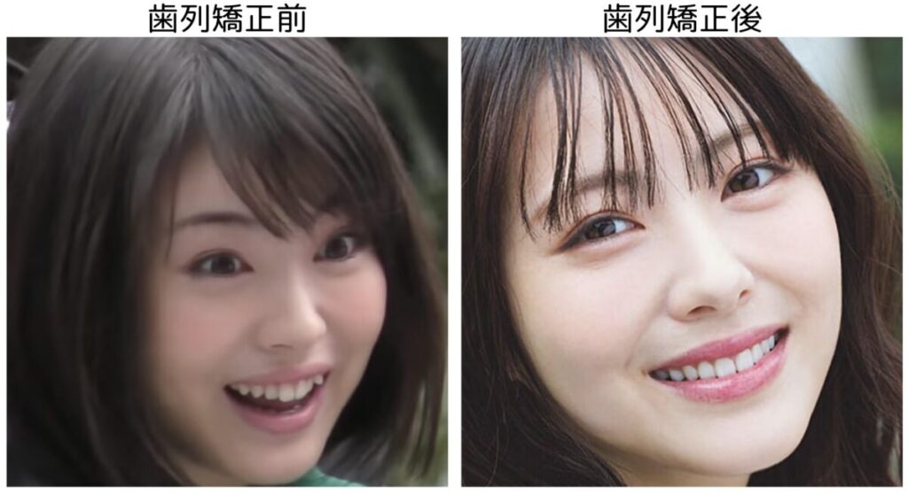 浜辺美波の歯列矯正前後の笑顔の比較