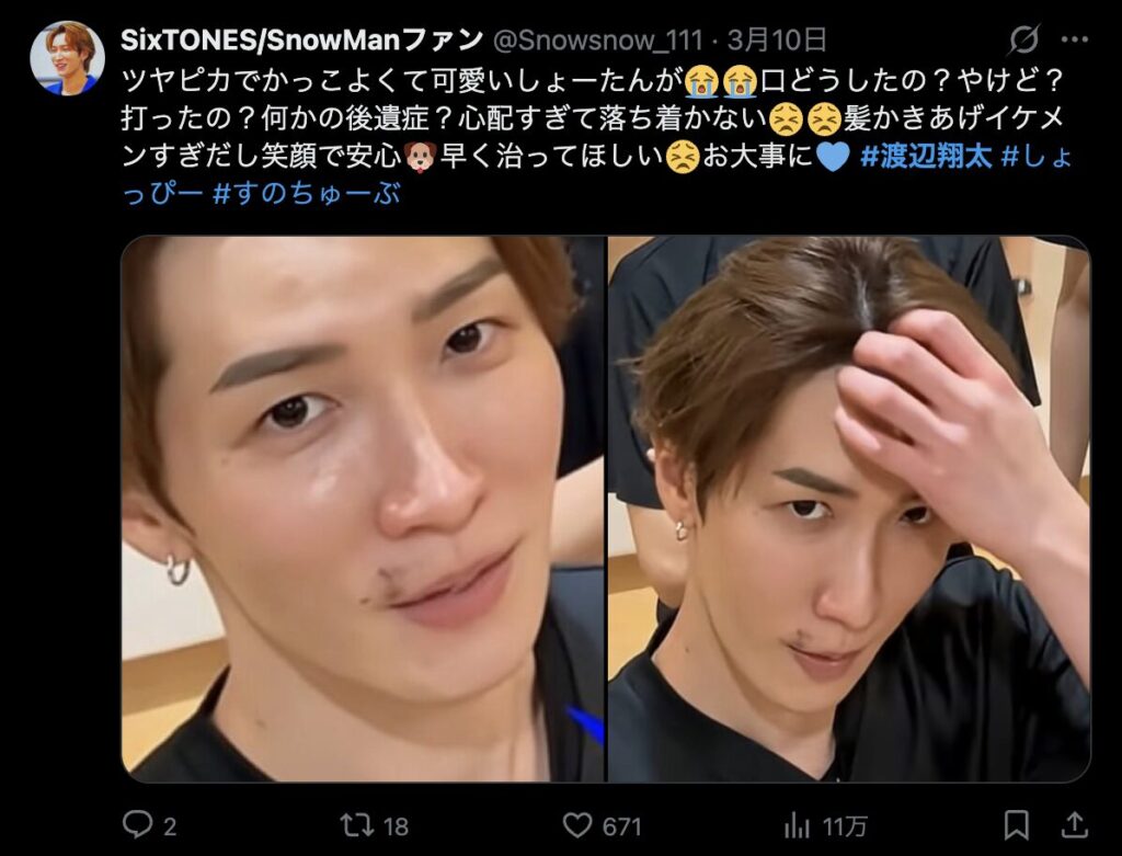 渡辺翔太の顔のあざが気になるというコメント