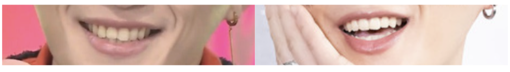 八木勇征の昔と現在の歯の比較画像1