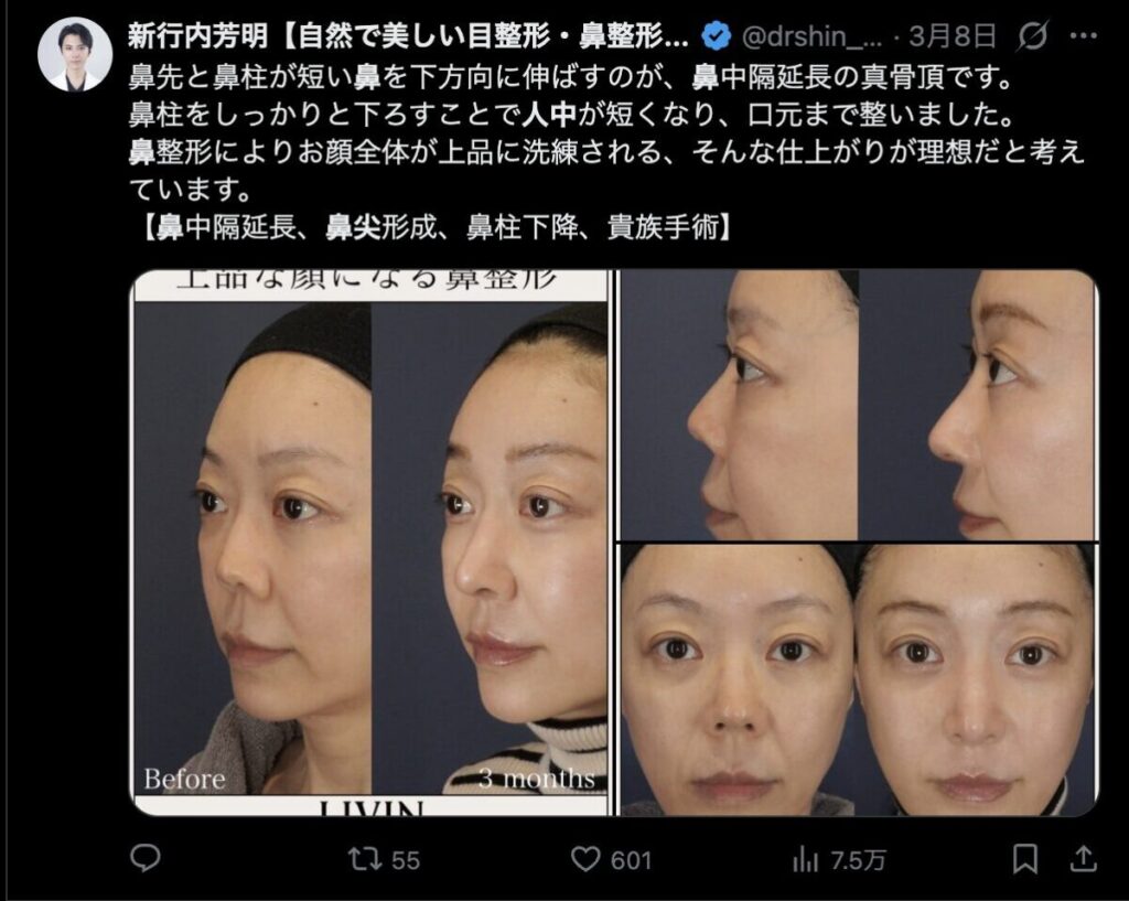 鼻の形と人中の長さの関係に関するコメント